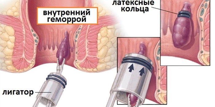 Как можно убрать геморрой в домашних условиях Как убрать геморроидальные узлы в домашних условиях