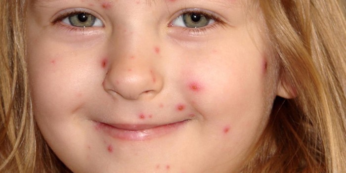 Прыщи на лице у ребёнка 13 лет Прыщи на лице у ребёнка 13 лет