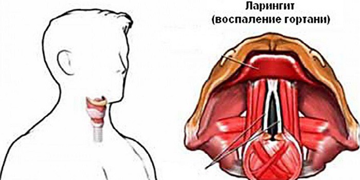 Кашель после удалении зубов Кашель после удалении зубов