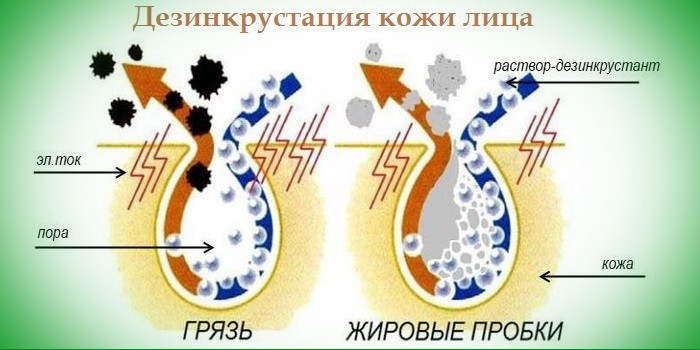 Механизм действия процедуры дезинкрустации кожи лица