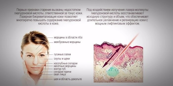 Действие лазерной биоревитализации на кожу