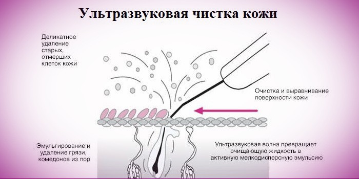 Техника ультразвуковой чистки кожи лица