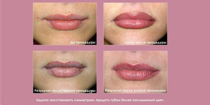 Татуаж губ: разновидности техник и цветов, цена, фото до и после микропигментирования Татуаж губ: разновидности техник и цветов, цена, фото до и после микропигментирования