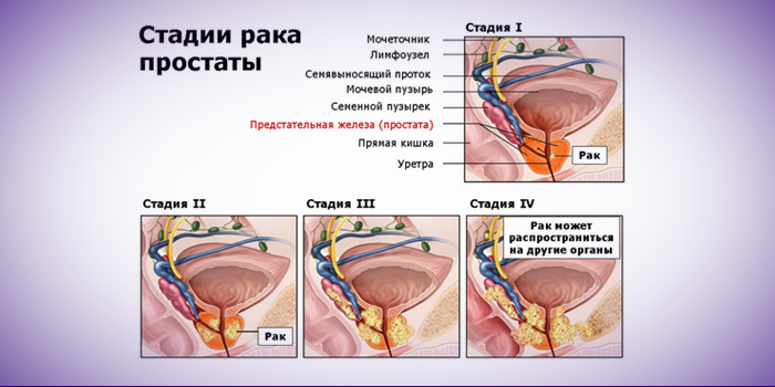 Диагностика опухоли простаты Диагностика опухоли простаты