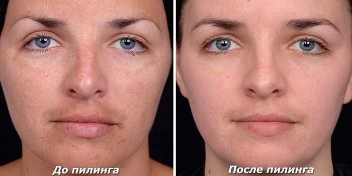 В итоге чистая кожа