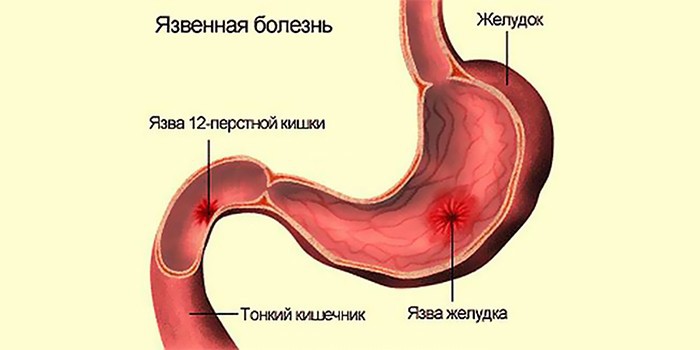 Сильно болит желудок что делать в домашних Сильно болит желудок что делать в домашних