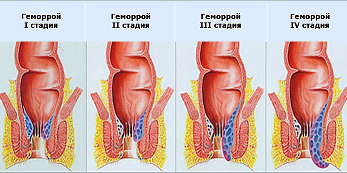 Внешний геморрой лечение домашних условиях Внешний геморрой лечение домашних условиях