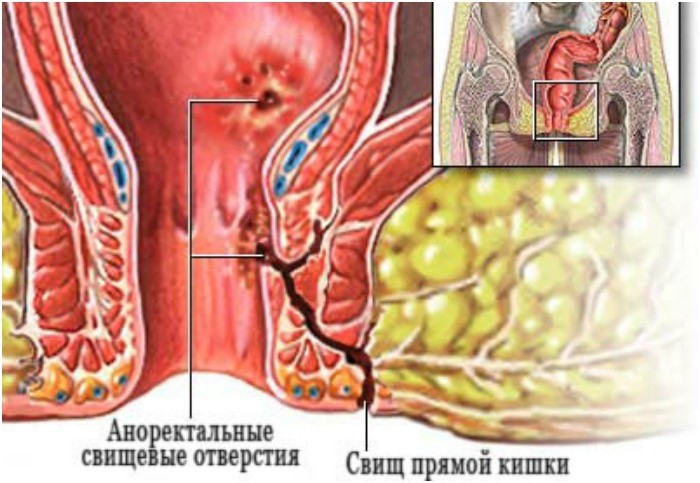 Свищ при хроническом парапроктите