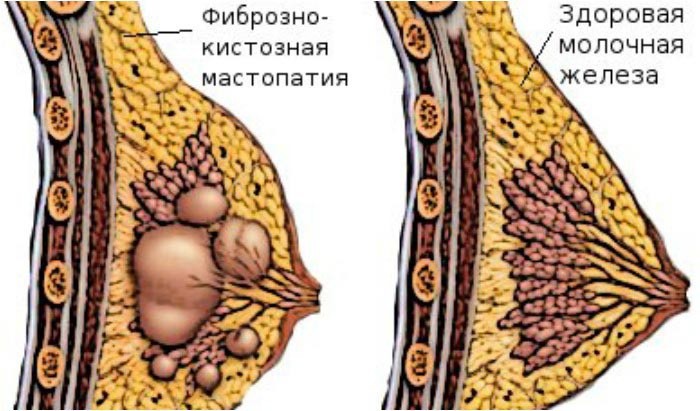 Рисунок изменен по типу фиброаденоматоза Рисунок изменен по типу фиброаденоматоза