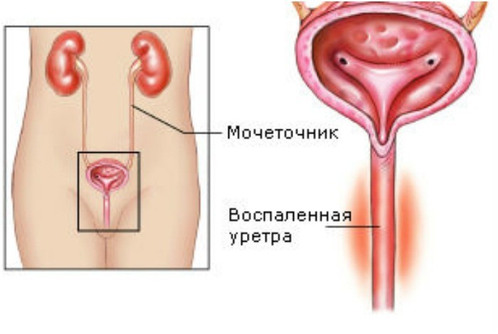 Воспаленная уретра