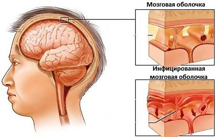 Сравнение здоровой и больной мозговой оболочки