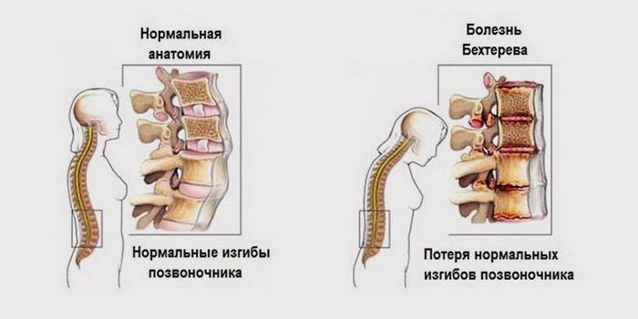 Сравнение нормального и больного позвоночника