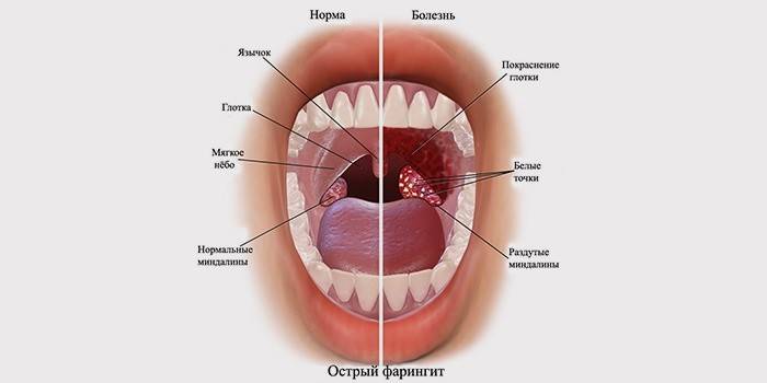Симптомы острого фарингита