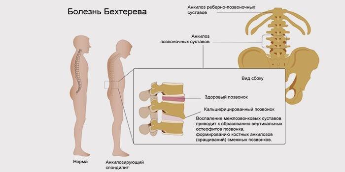 Симптомы болезни Бехтерева