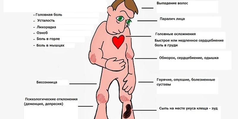 Симптомы Боррелиоза