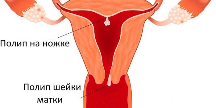 Места расположения и виды полипов матки