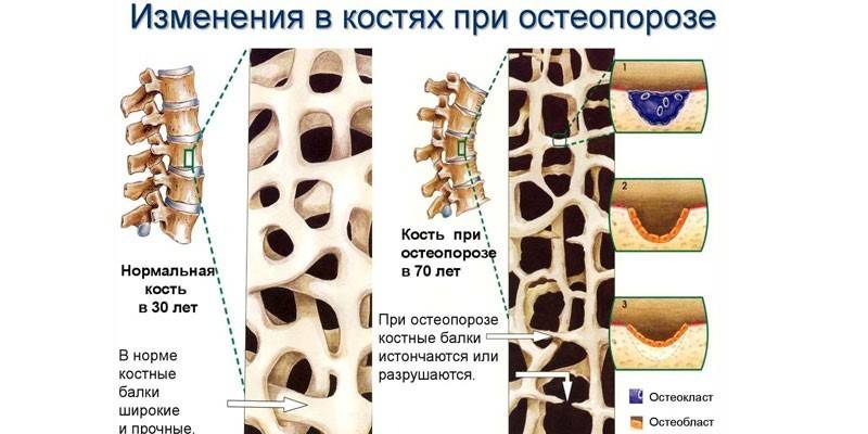 Изменения в костях при остеопорозе
