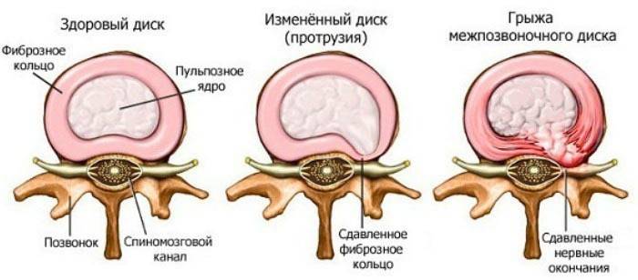 Стадии остеохондроза