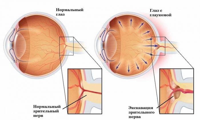 Глаукома на схеме