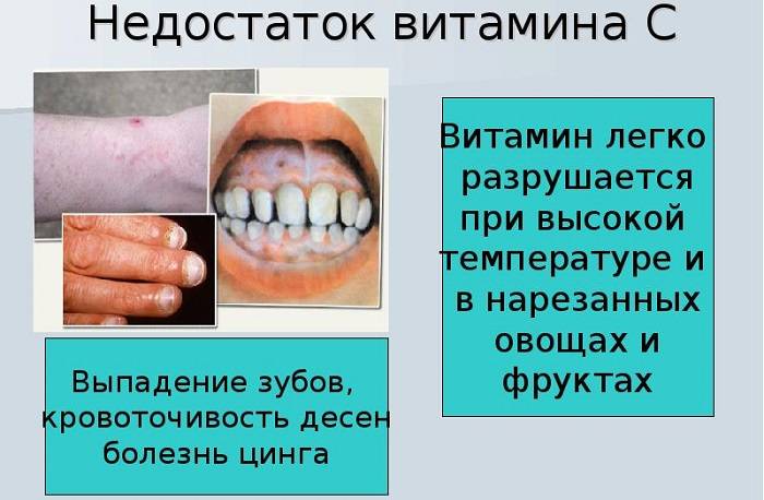 Влияние недостатка витамина С на зубы