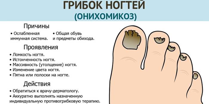 Причины и лечение грибка ногтей