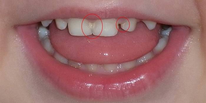 Гиперплазия зубной эмали