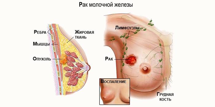 Рак груди на схеме