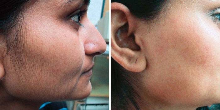 Лазерная эпиляция на лице: фото до и после