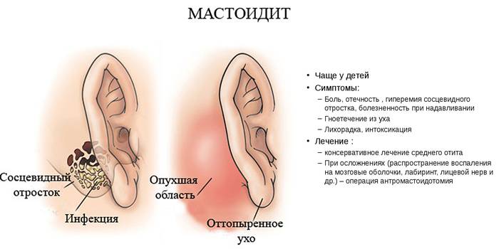 Симптомы и лечение мастоидита
