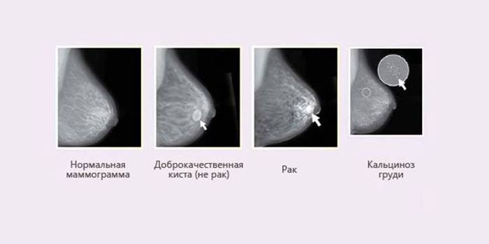 Результат мамограммы