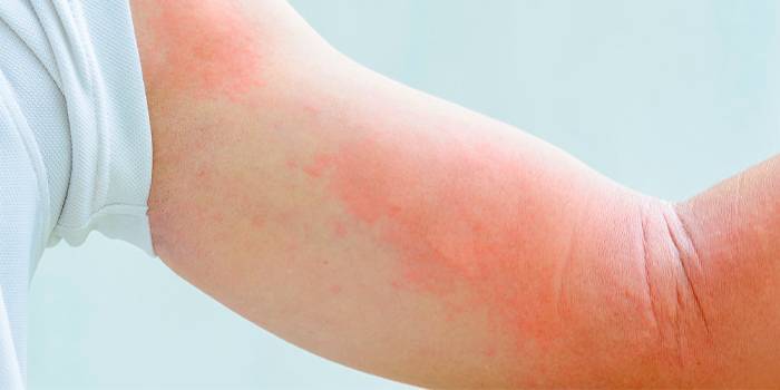 Проявление аллергии на коже