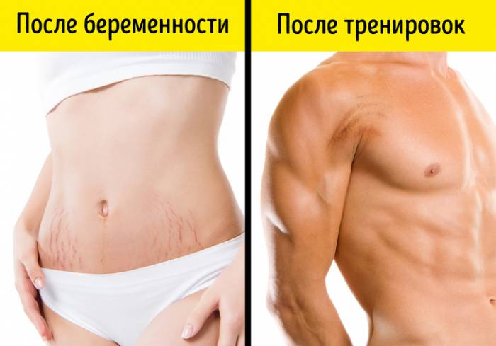 Растяжки на женском и мужском телах