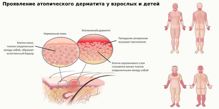 Проявление атопического дерматита у детей и взрослых