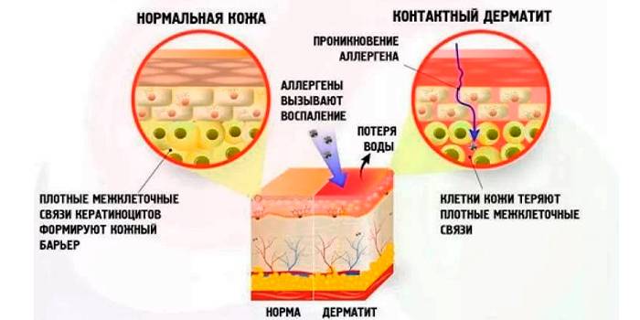 Как развивается контактный дерматит
