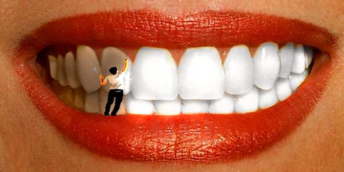 Отбеливание зубной эмали