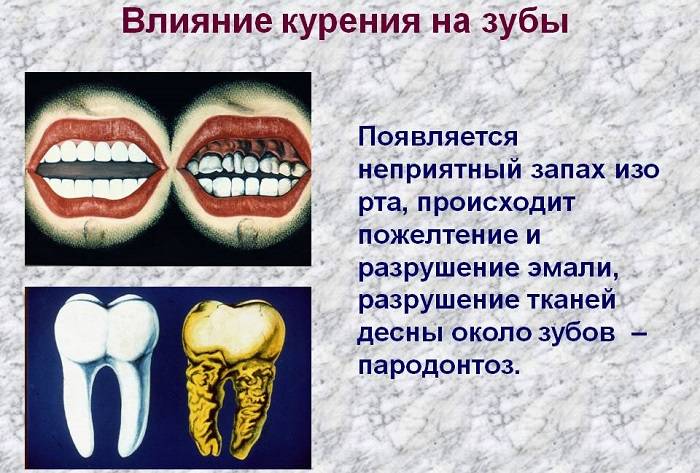 Влияние курения на зубы