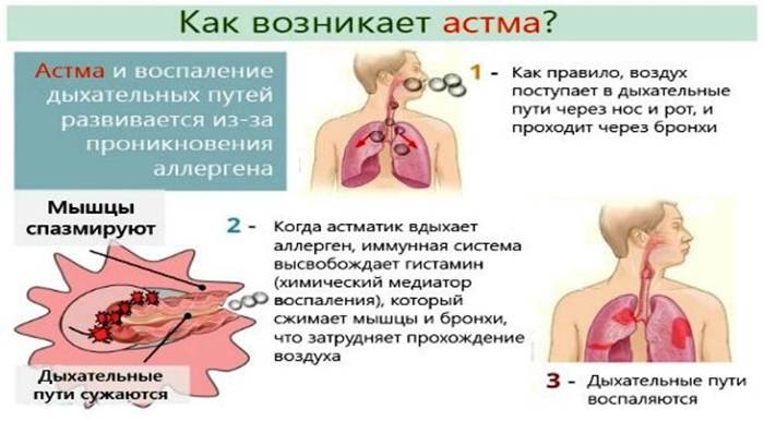 Как возникает астма