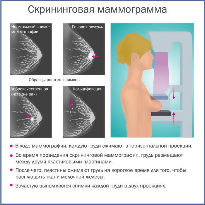 Скрининговая маммограмма