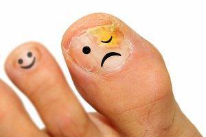 Виды и симптомы грибка ногтей на ногах