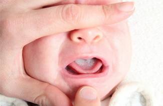 Белый налет во рту у ребенка
