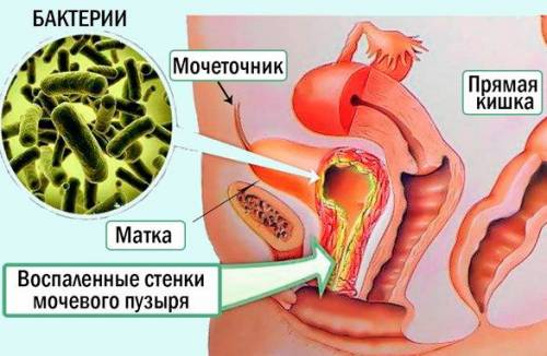 Как лечить инфекцию мочевого пузыря домашними средствами