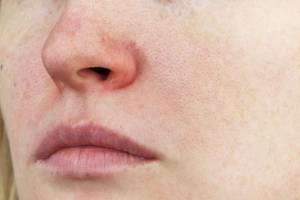 7 способов избавиться от покраснения вокруг носа