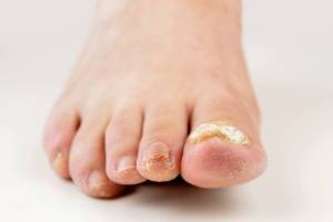8 основных причин появления грибка на ногах