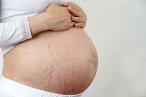 Растяжки во время беременности, можно ли их предотвратить