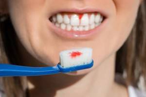 Будьте осторожны, если при чистке зубов кровоточат десны