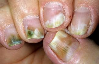 Заболевания ногтей на руках