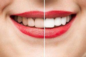5 средств для домашнего отбеливания зубов