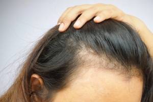 Причины выпадения волос на одной стороне головы