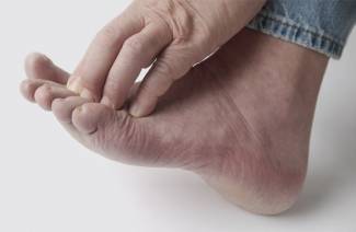 Лечение грибка между пальцами ног народными средствами
