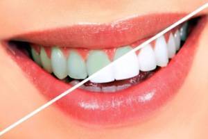 Домашние средства для отбеливания зубов